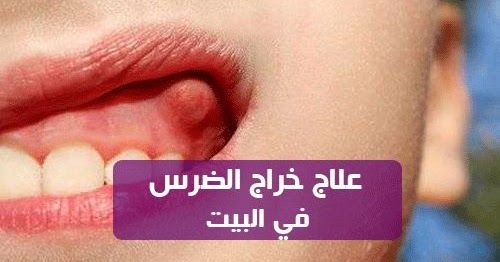 علاج خراج الضرس في البيت خراج الأسنان هو عبارة عن تكون مواد بكتيرية