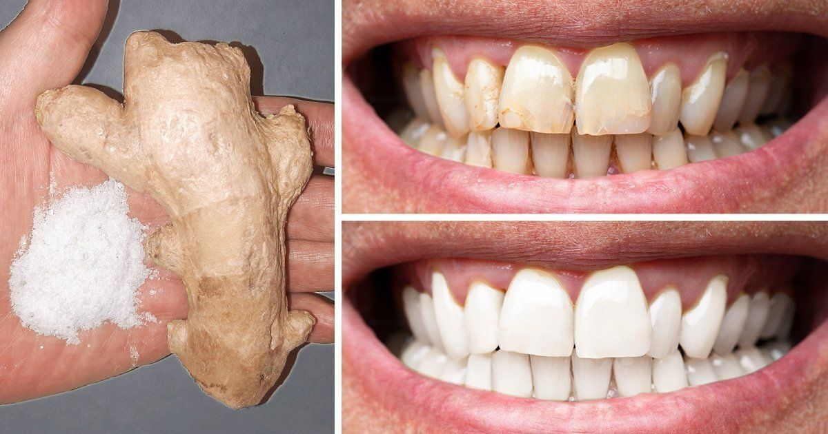 Comment Blanchir Les Dents En 2 Minutes? 28 Épinglé sur Blanchir les dents