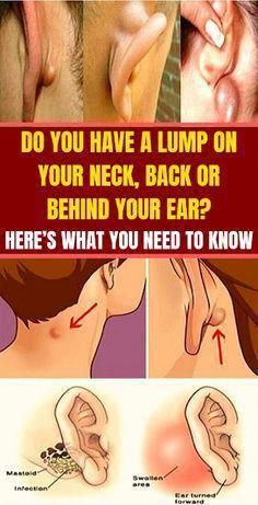 Vital Pieces of Lumps on Neck - Healthy Medicine T Vital Pieces of Lumps on Neck - Healthy Medicine T