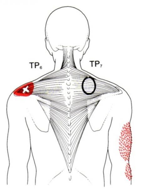 trapezius the trigger point referred pain guide chiropractic