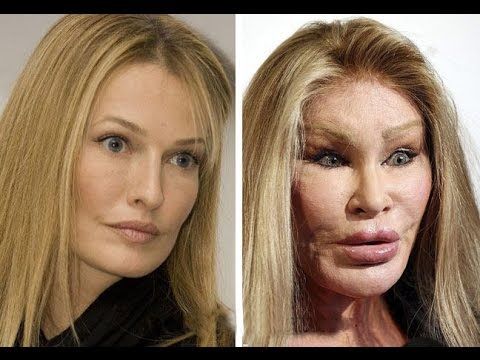 Cirugias que salieron mal antes y despues de adelgazar