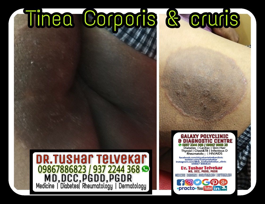 tinea corporis buttocks tinea corporis buttocks