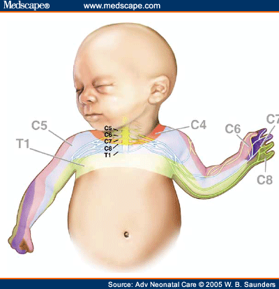 erb duchenne