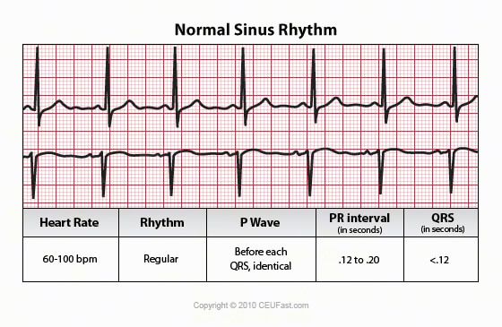 ceufast com normal sinus rhythm continuing education sinus rhythm chart