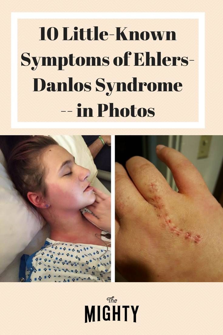 10 Benefits Of Having Ehlers Danlos Syndrome Artofit 10-benefits-of-having-ehlers-danlos-syndrome-artofit