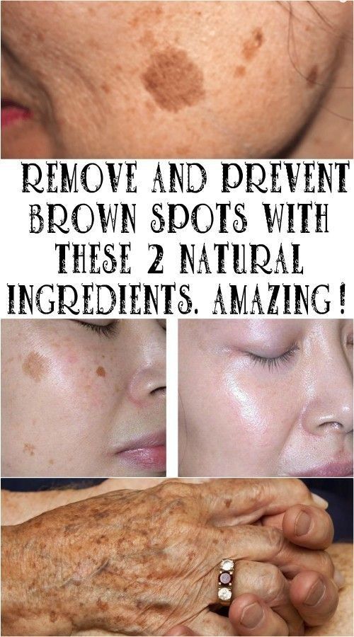 REMOVE AND PREVENT BROWN SPOTS WITH THESE 2 NATURAL INGREDIENTS remove-and-prevent-brown-spots-with-these-2-natural-ingredients