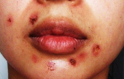 The Scabs Can Be Just As Embarrassing As The Acne Itself It S An Indicator That You Have Pimples Luckily Acne Scab Chest Acne Remedies Severe Acne Remedies