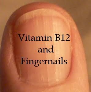 Vitamin B12 and Fingernails – Your Roadmap to Heal Vitamin B12 and Fingernails – Your Roadmap to Heal