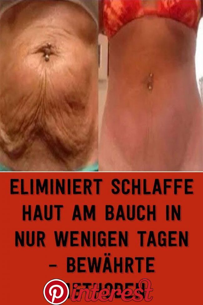 Eliminiert schlaffe Haut am Bauch in nur wenigen Tagen Eliminiert schlaffe Haut am Bauch in nur wenigen Tagen