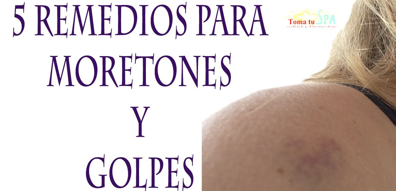 Remedios para moretones por golpes