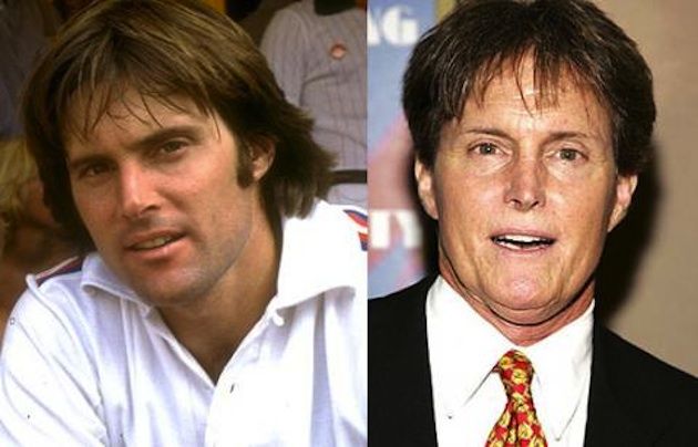 Bruce Jenner Plastic Surgery Before And After Stars Through The Years Plastic Surgery