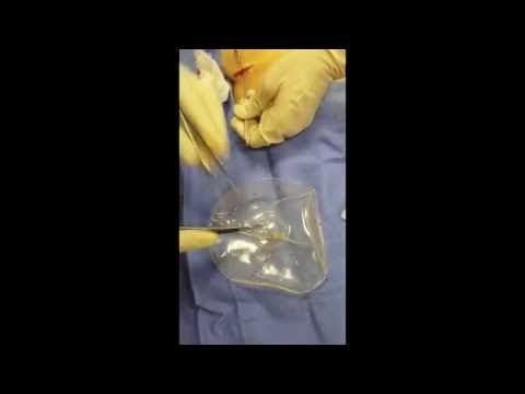 Thanks Deflated saline breast casually Regret, Deflated saline breast