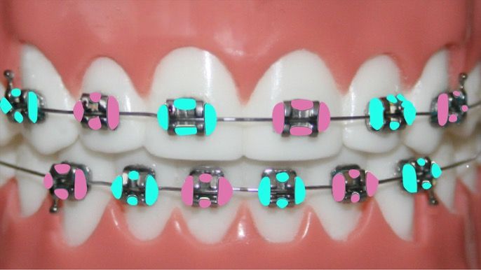 Follow Ya Average Girl For More Pins ♛ Braces Colors Cute Braces