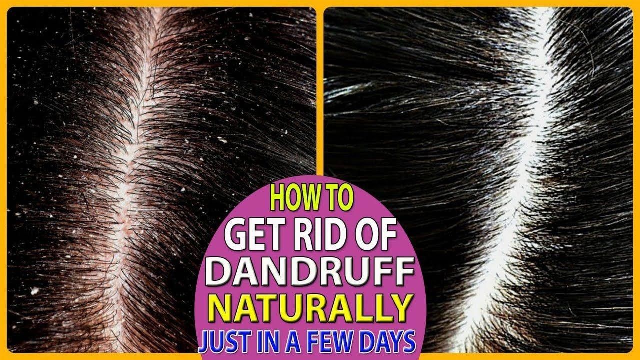 How to Get Rid of Dandruff Naturally in a Few DaysHealth