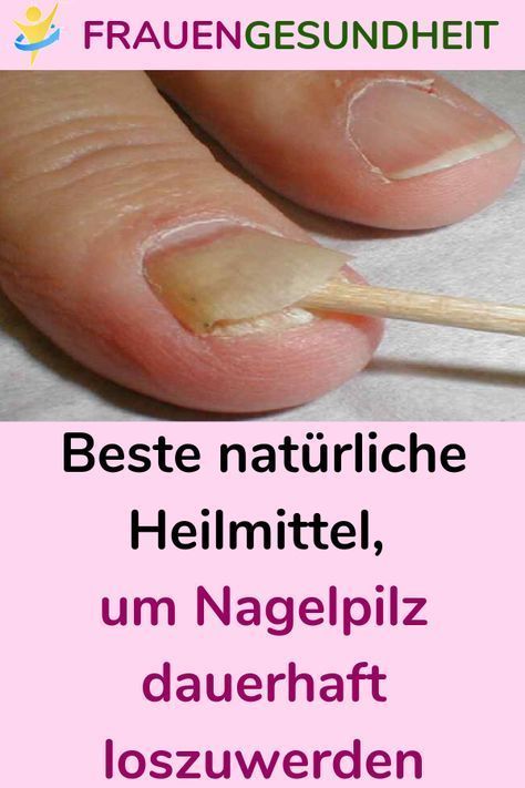 Lindert umgehend den Juckreiz und übermäßiges Schwitzen Zerstört die Ursache für das Wachstum von Pi...