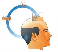 Is hair transplant the best option