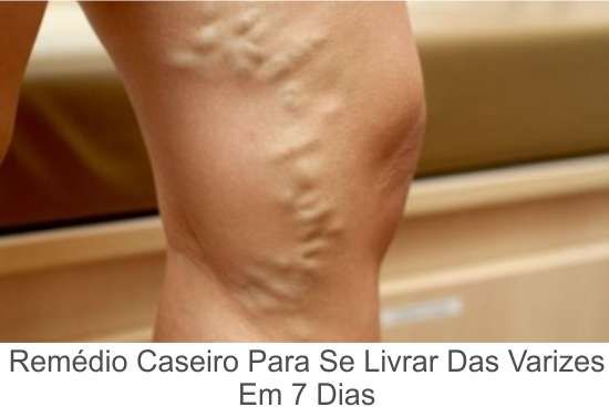 panza de propolis în varicoza cum de a avertiza educaia varicoza