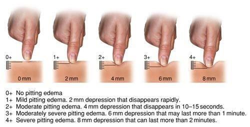 pitting oedema nursing school nurse nursing information