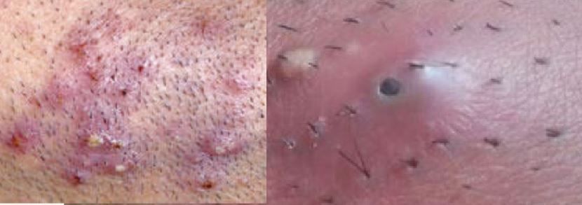 Skin Care Advice That Will Help At Any Age Infected