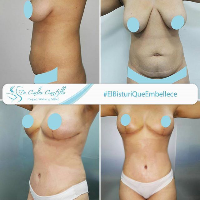 ejercicios recomendados para despues de una abdominoplastia ejercicios recomendados para despues de una abdominoplastia