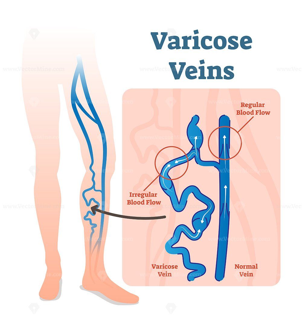 Varicose veins with irregular blood flow and healthy veins vector illustration diagram scheme. Varicose veins are veins that have become enlarged and twisted. #varicose #medicine #vein #blood #leg #commercial #vector #illustration → Get this Illustration for Commercial Use! Varicose Veins Causes, Varicose Vein Removal, Varicose Veins Treatment, Vein Surgery, Laser Surgery, Great Saphenous Vein, Vein Diseases, Disease Symptoms, Vascular Disease
