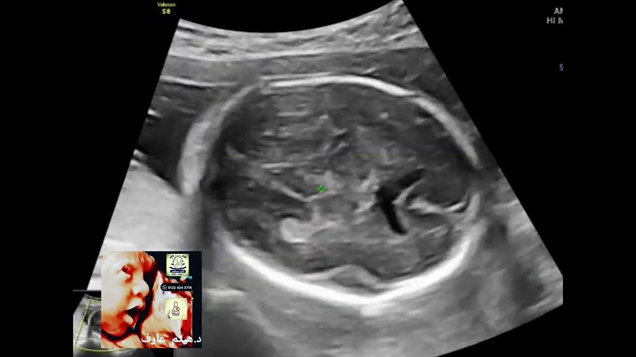 Corpus Callosum Fetal Ultrasound corpus-callosum-fetal-ultrasound