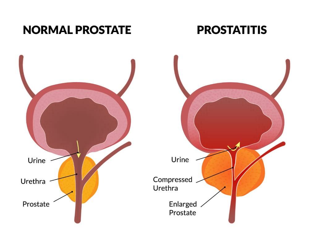 gyulladás eltávolítása a prosztatával hogy fáradt vagyok a prosztatitisből