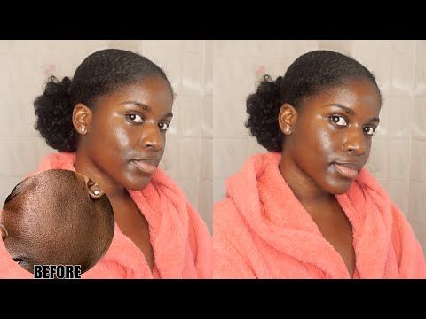 skincare hyperpigmentation