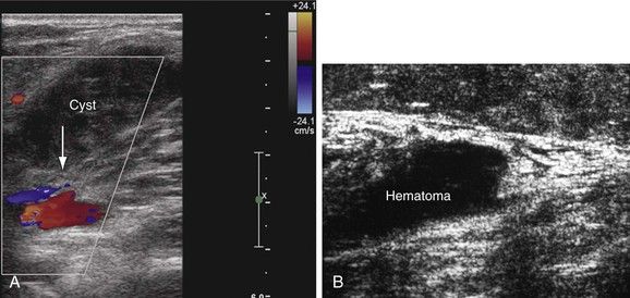 Incidental Findings In Patients Who Underwent Ultrasound Examination To Rule Out Deep Venous Thrombosis A Gastrocnemius Muscle Thrombosis Achilles Tendonitis