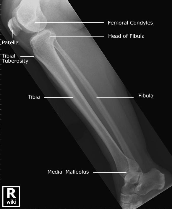 tib fib bones tib fib bones