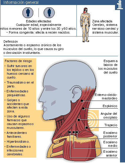 Fichas De Enfermedades Tortícolis Esternocleidomastoideo Contracturas Musculares Sistema Muscular