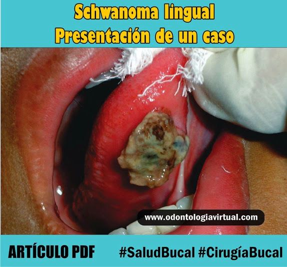 NEURILEMOMA BUCAL EBOOK DOWNLOAD NEURILEMOMA BUCAL EBOOK DOWNLOAD