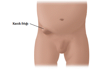 Adem Dervisoglu Tarafindan Inguinal Herni Kasik Fitigi