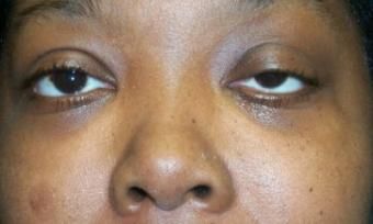 Ptosis Before With Images Brow Lift Surgery Endoscopic Brow Lift Surgery