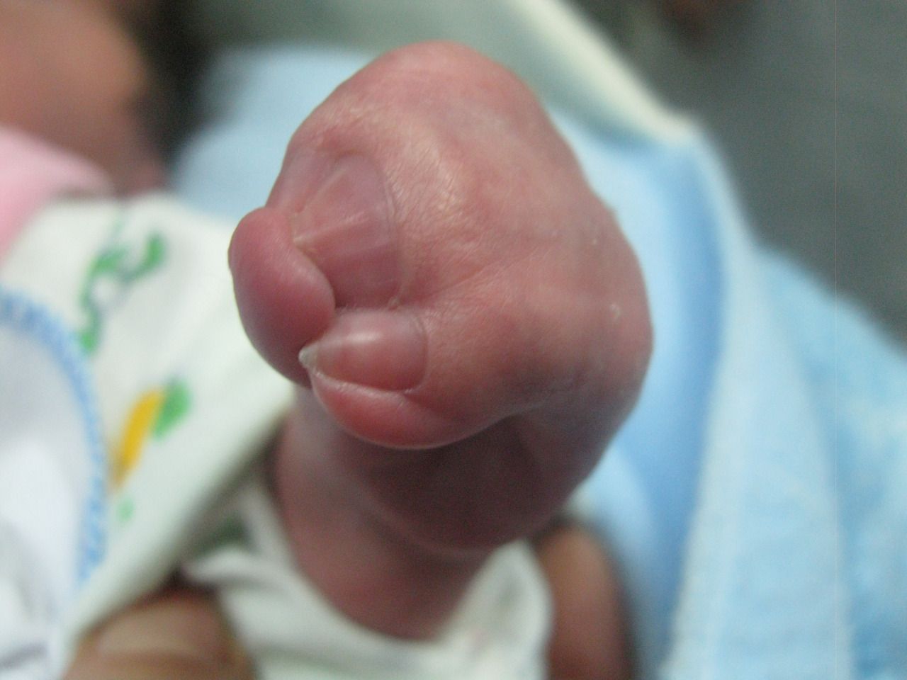 Malformalady Syndactyly Of Several Digits Syndactyly Is A Congenital Malformalady Syndactyly Of Several Digits Syndactyly Is A Congenital