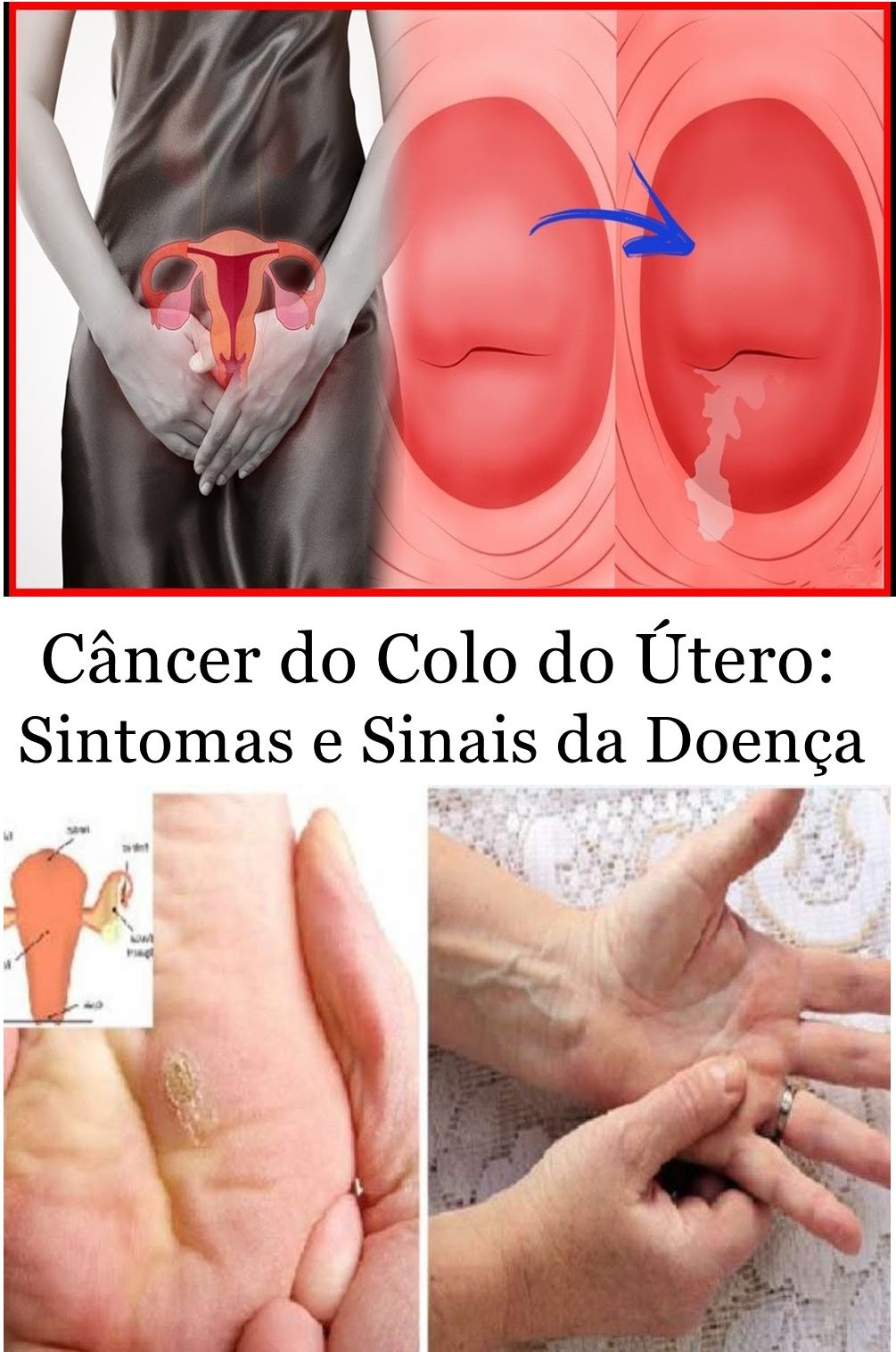 sintomas de cancer no utero ou ovario
