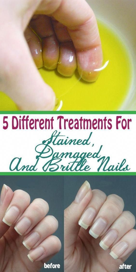 What You Should Do About Hair Loss and Brittle Nai What You Should Do About Hair Loss and Brittle Nai