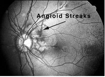 Cowdens Syndrome And Eyes Angioid Streaks Are Cracks In Cowdens Syndrome And Eyes Angioid Streaks Are Cracks In