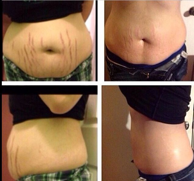 dramatic results on her stretch marks using the it works body wraps stretch works
