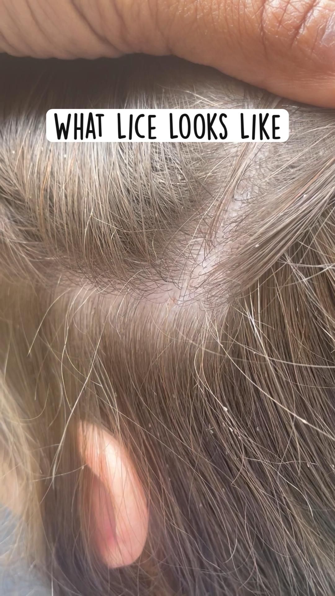 Lice infestation what head lice looks like – Artofit
