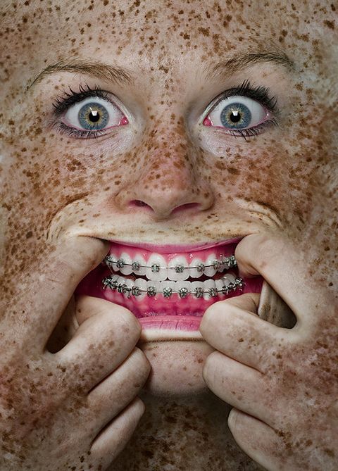 Redhead freckles braces pale skin She traded her virginity