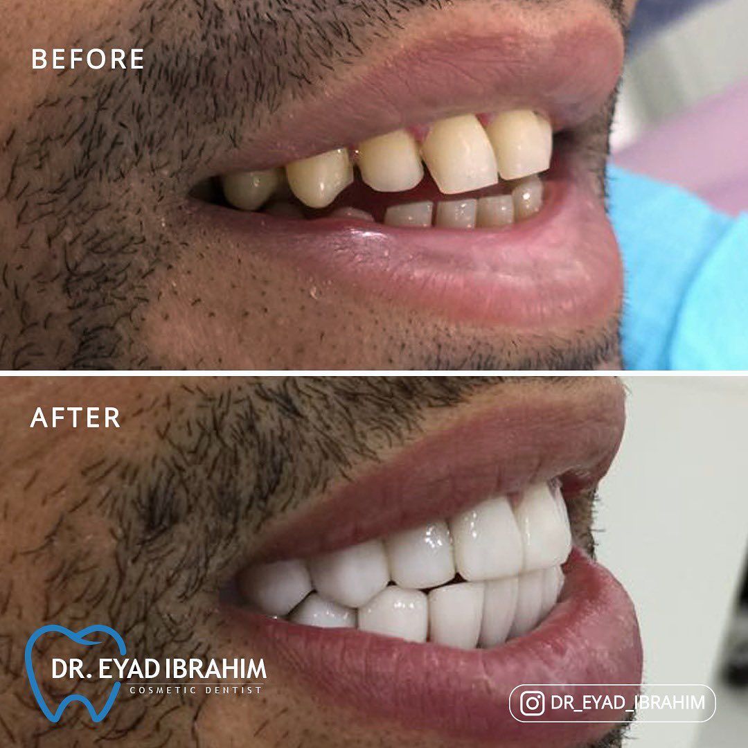 ابتسامة جميلة على يد د اياد ابراهيم اخصائي جراحة وتجميل الأسنان ابتسامة هوليود زيركون فلر بوتكس ع Dentist Cosmetic Dentist Sleep Eye Mask