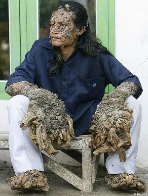 10 unusual genetic mutations in humans biology pinterest