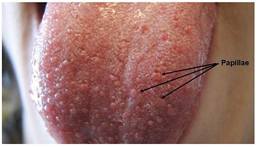This Is Why You Have Swollen Lie Bumps On Your Tongue Lie Bumps On Tongue Bumps On Tongue Tongue Ulcer Remedies