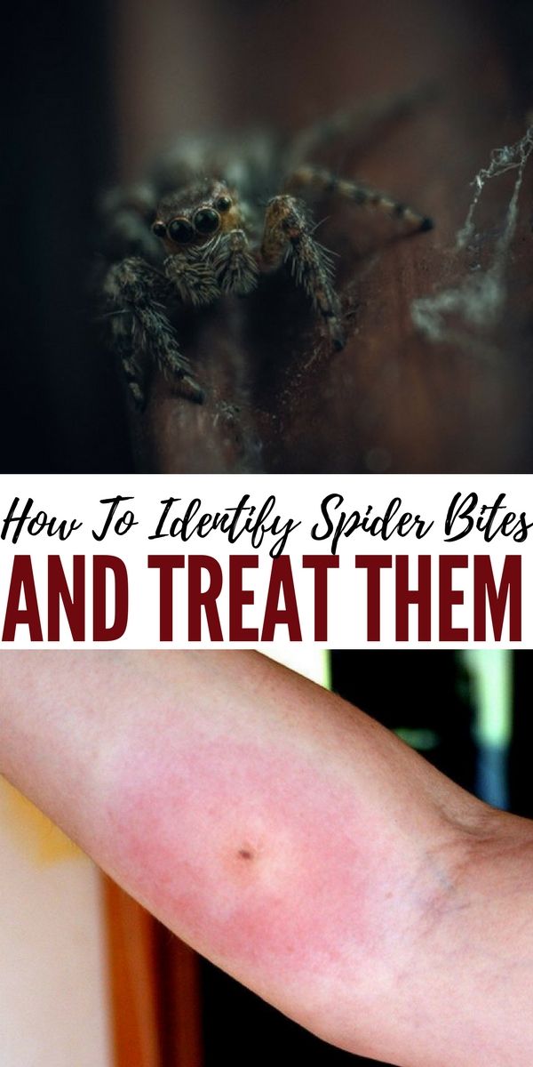 identify the deadly spiders of north america treating spider bite chart