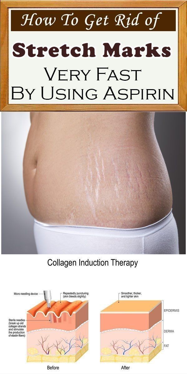 Get Rid of Stretch marks fast using aspirin Stretch