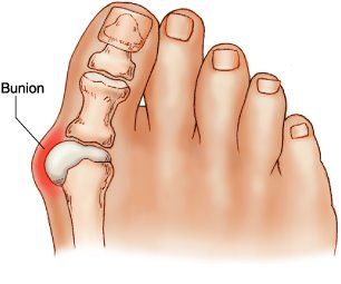 Pin By Sue Jenkins On Interests Natural Cures Natural Health Remedies Get Rid Of Bunions
