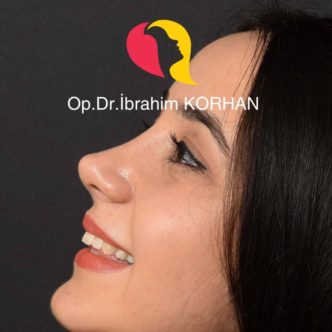 Goruntunun Olasi Icerigi 1 Kisi Yakin Cekim Rhinoplasty Nose Jobs Rhinoplasty Nose Job
