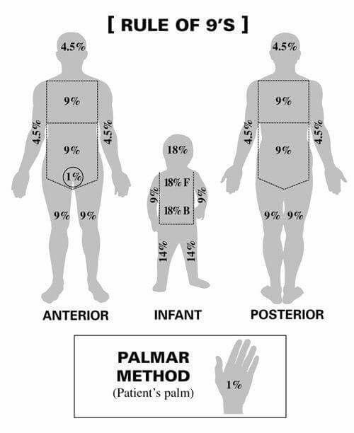 Rule Of Nines Burn Chart Children