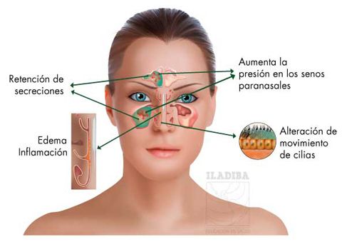 La mejor medicina para secar los senos paranasales